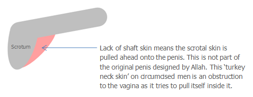 Turkey neck (Penoscrotal Webbing) - scrotum pulled by shaft skin